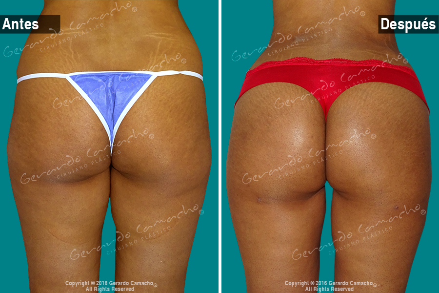 Testimonio gluteoplastia Bogota